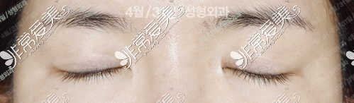 韩国431整形眼部修复真实后记分享 揭秘431眼修复真实技术!