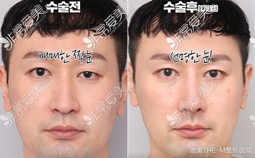 分享韩国迪美眼肌矫正术经历,上睑下垂矫正多数人都需要!