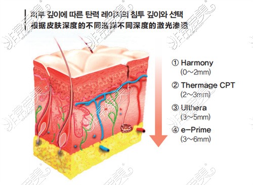 韩国JF医院根据皮肤问题深度选择适合的激光