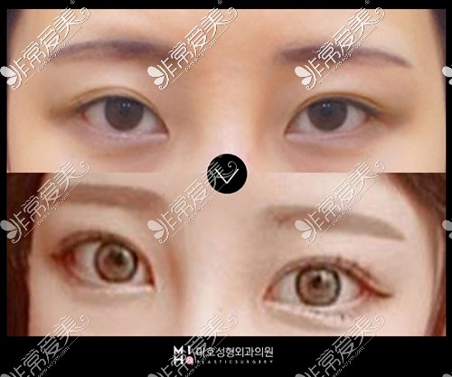 韩国MIHO整形外科眼部自然粘着+提肌手术