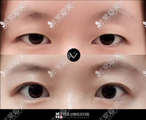 韩国美好MIHO双眼皮提肌对比照片