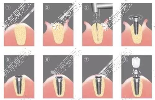 种植牙示意图