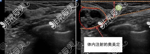 北京取奥美定哪家医院取的好?取得干净技术好看这几家!