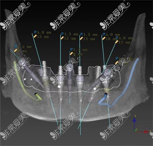 种植牙CT图