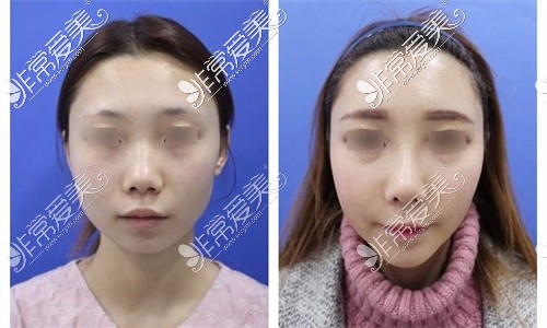 韩国可来熙整形外科隆鼻手术