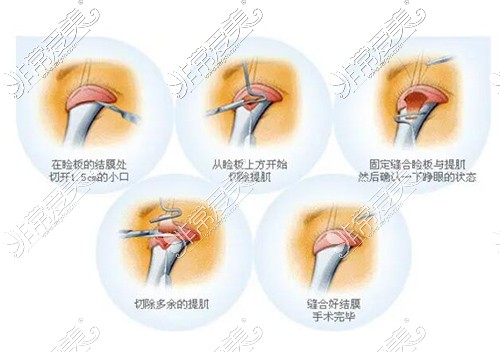 眼提肌修复方式改善