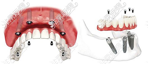全口种植牙示意图