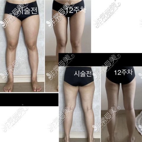 韩国365mc吸脂医院大腿吸脂对比图