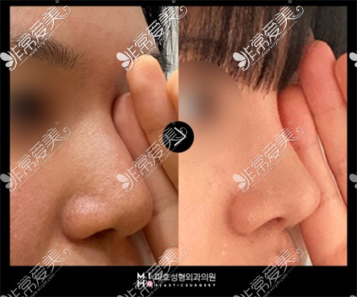 韩国美好MIHO整形外科鼻部矫正对比