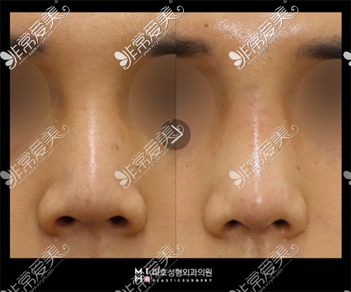 韩国美好MIHO整形外科鼻整形前后图
