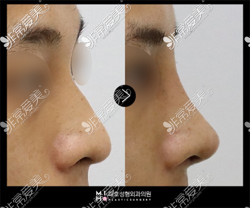 韩国美好MIHO整形外科驼峰鼻矫正对比照