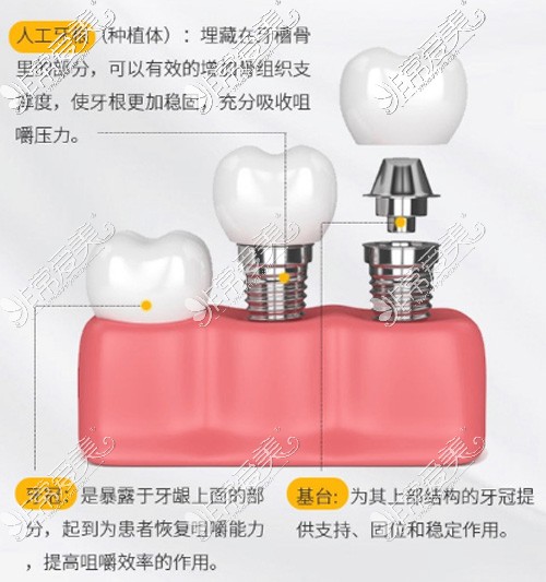 種植牙結(jié)構(gòu)介紹