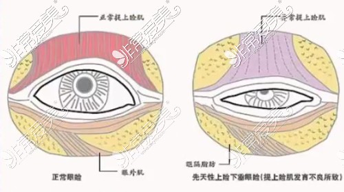 上睑正常情况和上睑下垂情况