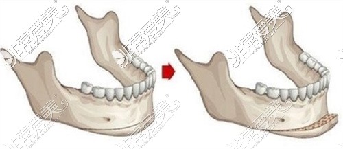 下颏整形示意图