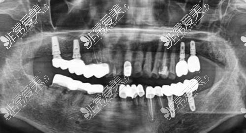 全口种植牙术后ct照