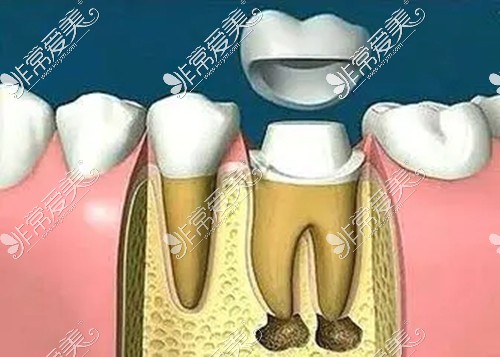 长沙根管治疗加牙冠多少钱一颗?做一颗牙冠能保几年?