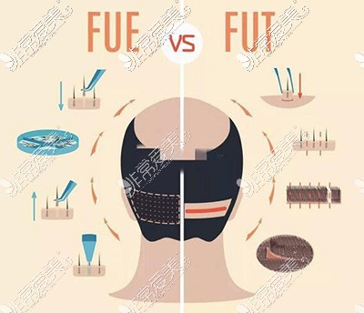 不同的植发方式卡通图