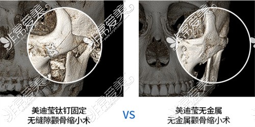 韩国美迪莹做整形颧骨对比图