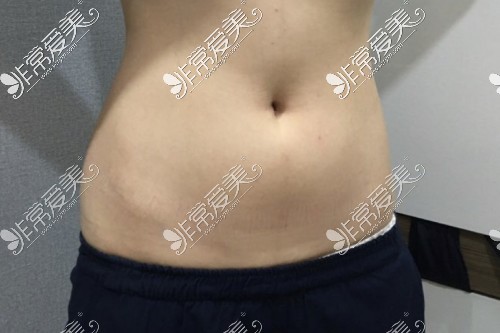 吸脂手术可以瘦多少斤？韩国Qline医院吸脂两月减重4公斤！