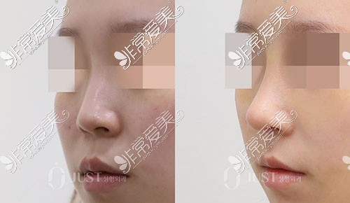 韩国JUST整形外科隆鼻手术