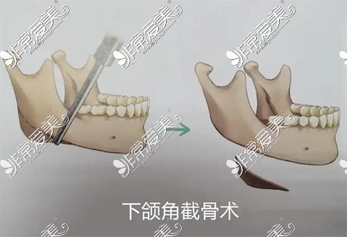 下颌角整形手术方式图