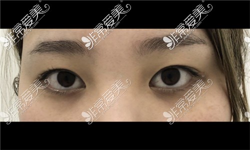 韩国可来熙整形双眼皮修复术前