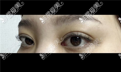 韩国可来熙整形双眼皮修复术后