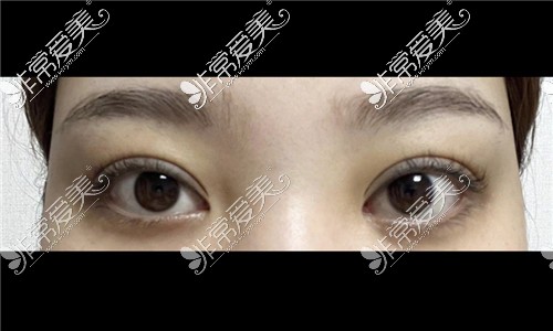 韩国可来熙整形双眼皮修复术后