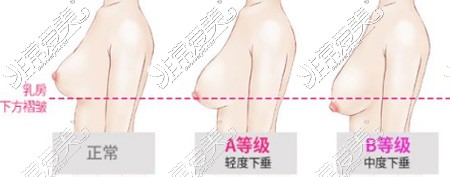 韩国id整形隆胸手术图片