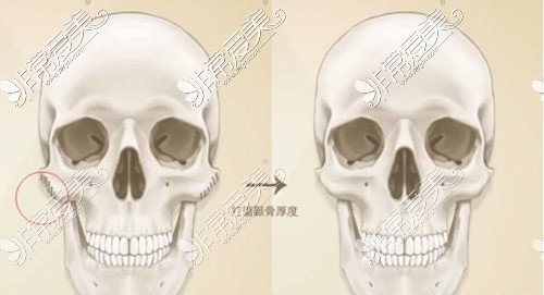 长沙颧骨颧弓内推大概手术费用是多少?低价磨骨一年后后悔!