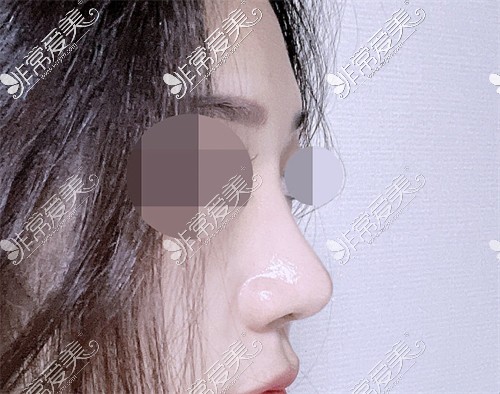 韩国星愿Byul整形医院鼻部矫正术后图