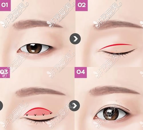 韩国4月31日整形外科双眼皮手术特点展示