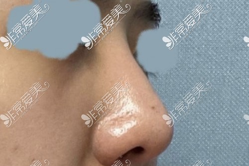 韩国VG百利酷鼻子硅胶假体手术图片
