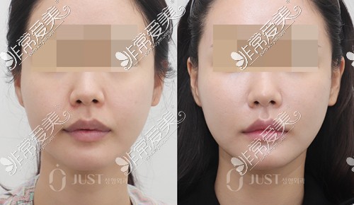 韩国JUST整形外科真人前脸颊轮廓提升正面对比照