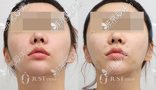 韩国JUST整形外科真人前脸颊轮廓提升对比照