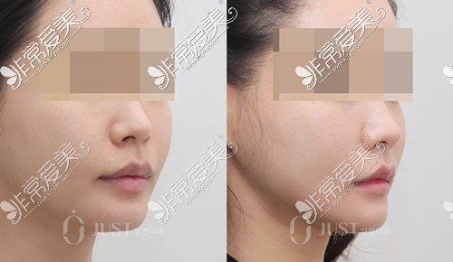 韩国JUST整形外科脸部提升右侧面前后的对比