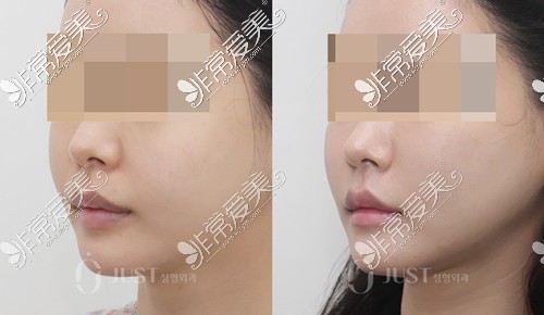 韩国JUST整形外科脸部提升左侧面前后对比照