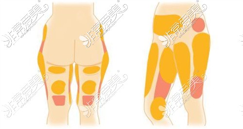 大腿脂肪堆积示意图