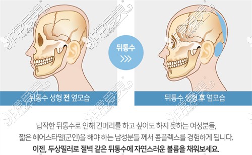 韩国Qofill&gyul整形外科头部填充原理展示