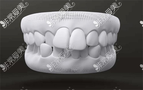 牙齿畸形展示