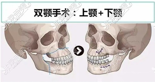 正颌手术后多久能上班