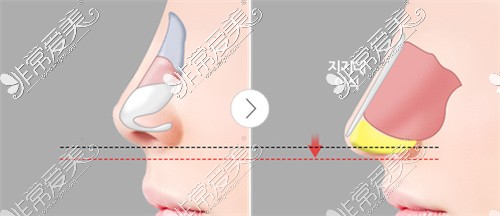 假体隆鼻改善短鼻情况