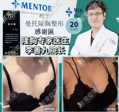 韩国做隆胸好的整形医院推荐,盘点擅长隆胸整形医院名单!