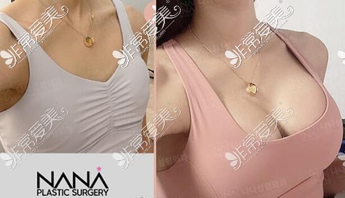 韩国NANA隆胸展示图照片