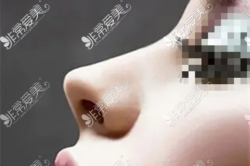 鼻部整形示意图