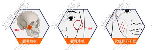 北京圣嘉新医疗美容医院张立天医生的颧骨技术