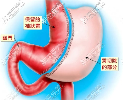 切胃手術(shù)示意圖