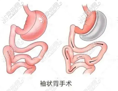 袖状胃手术示意图