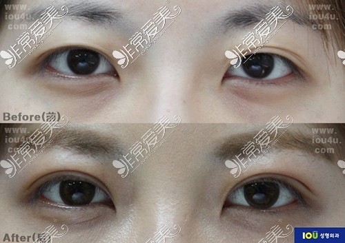韩国IOU整形外科埋线双眼皮+上睑下垂矫正手术