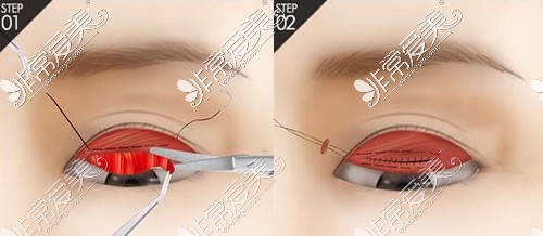 韩国4月31日整形外科双眼皮手术特点